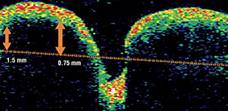 Tomografía óptica coherente OCT en Drusen de nervio óptico 